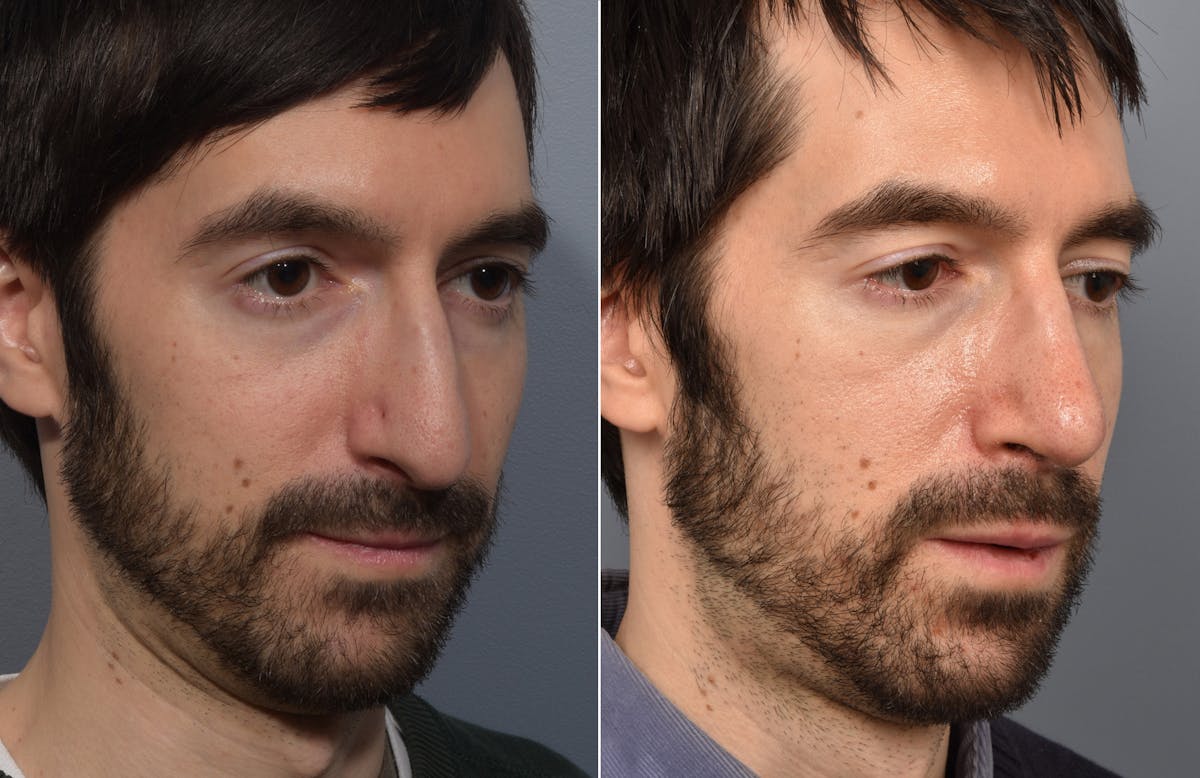 Rhinoplasty Before & After Gallery - Patient 168684 - Image 6