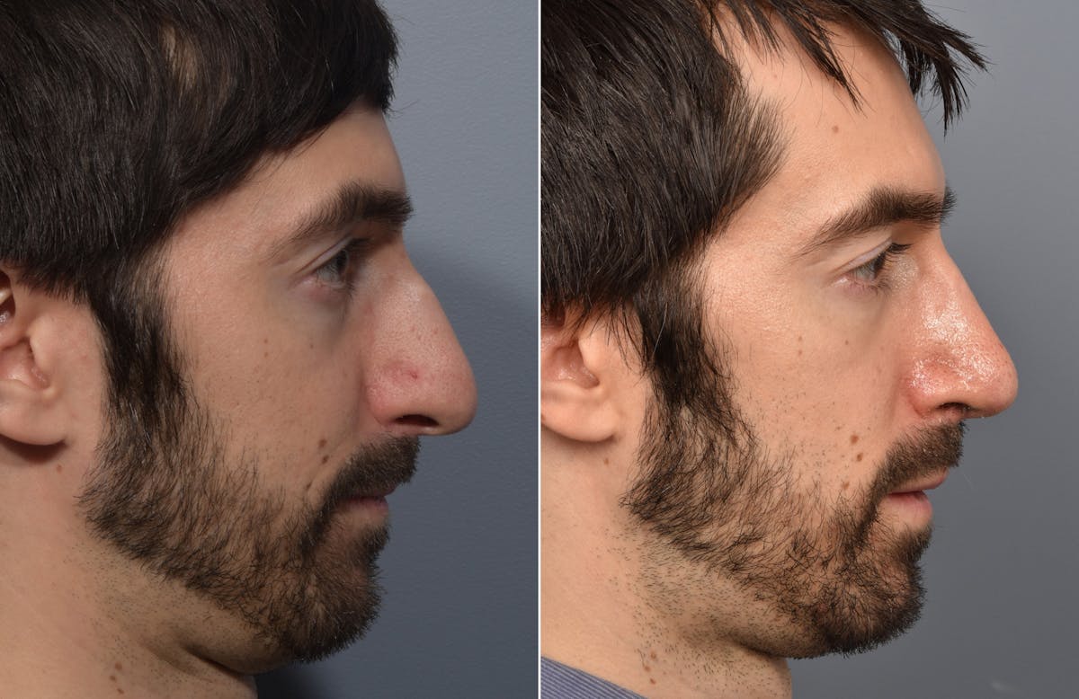 Rhinoplasty Before & After Gallery - Patient 168684 - Image 3