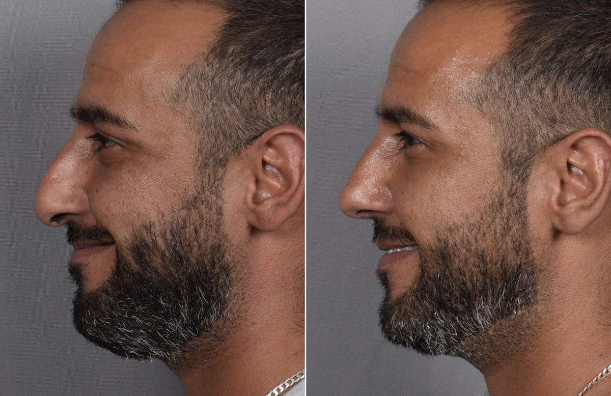 Rhinoplasty Before & After Gallery - Patient 253604 - Image 2