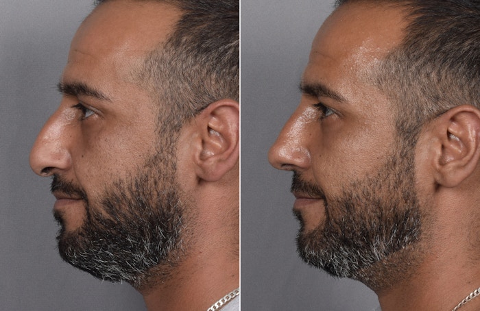 Rhinoplasty Before & After Gallery - Patient 253604 - Image 1