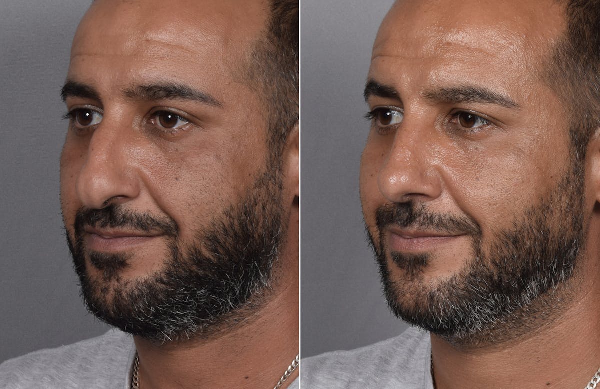 Rhinoplasty Before & After Gallery - Patient 253604 - Image 6