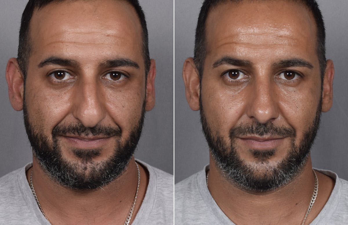 Rhinoplasty Before & After Gallery - Patient 253604 - Image 7