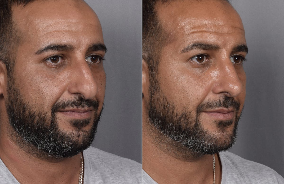 Rhinoplasty Before & After Gallery - Patient 253604 - Image 5