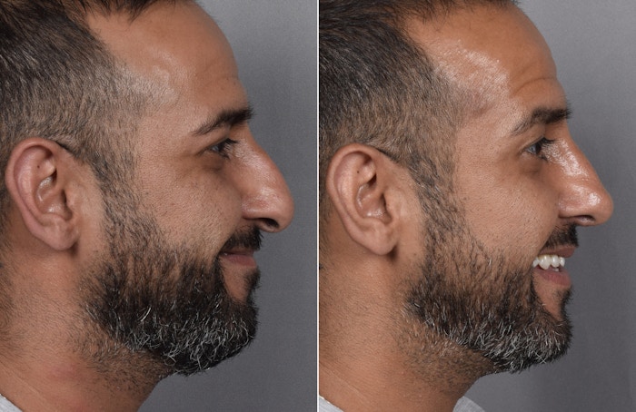 Rhinoplasty Before & After Gallery - Patient 253649 - Image 1