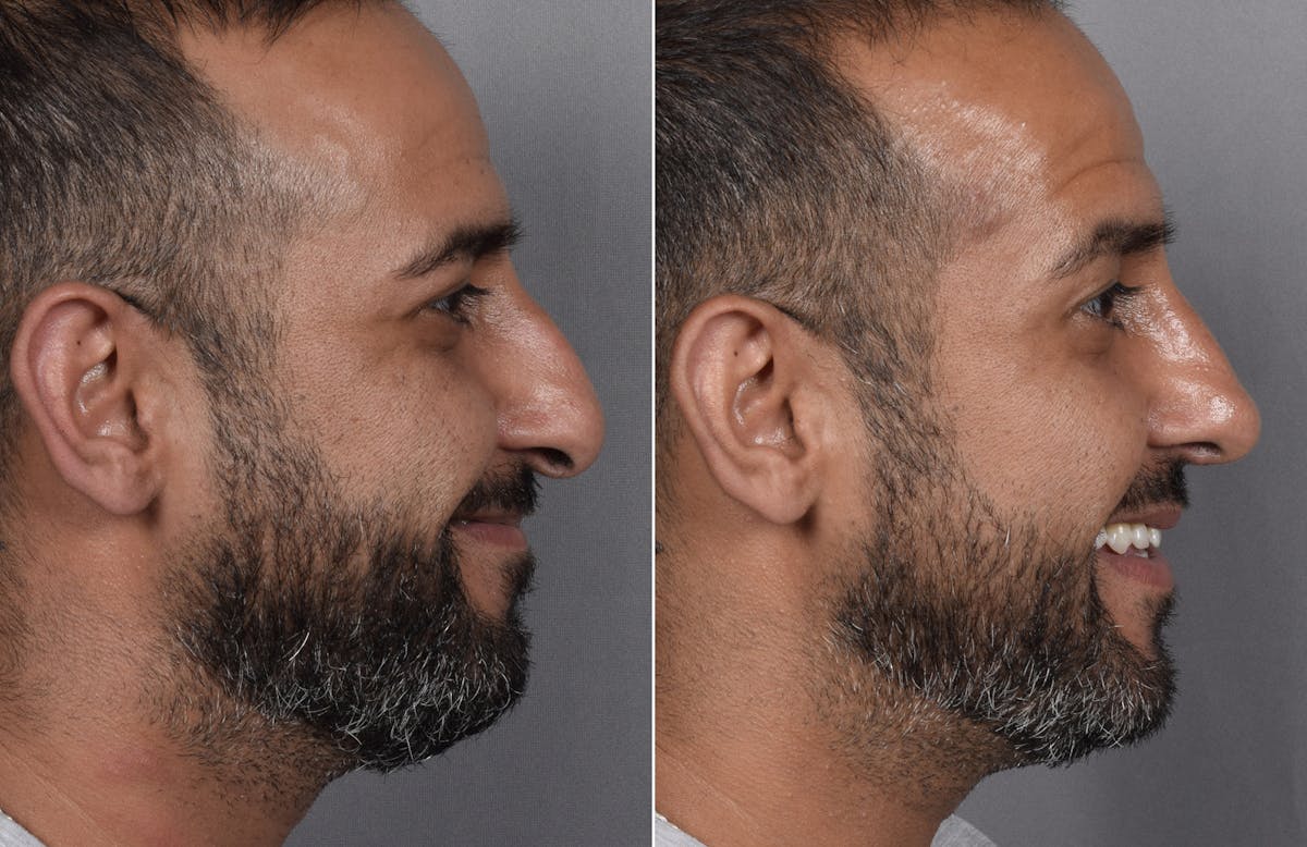 Rhinoplasty Before & After Gallery - Patient 253604 - Image 4