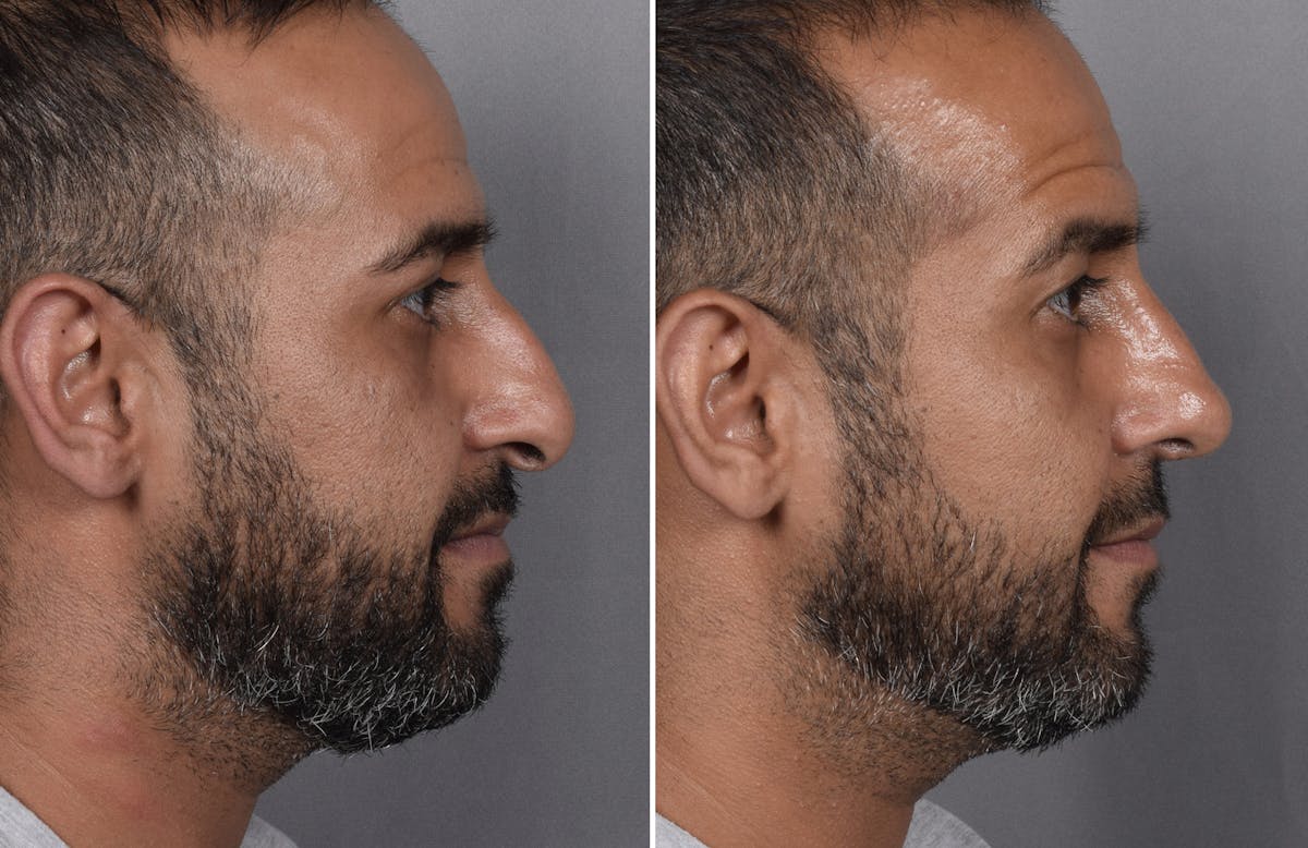 Rhinoplasty Before & After Gallery - Patient 253604 - Image 3
