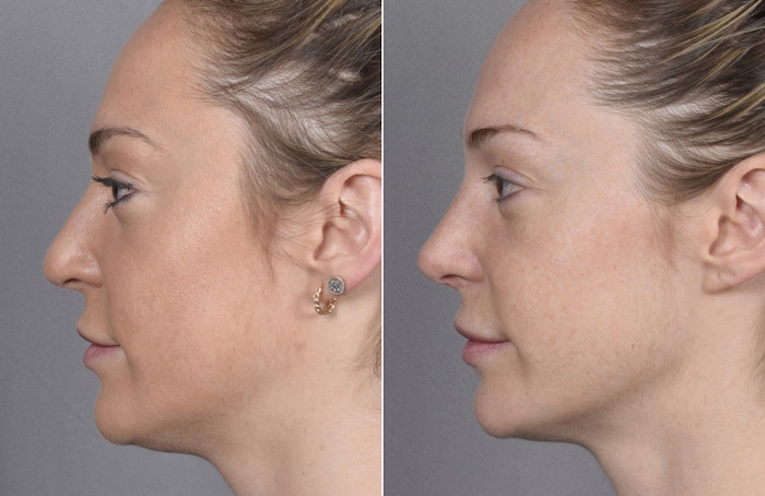 Rhinoplasty Before & After Gallery - Patient 347275 - Image 1