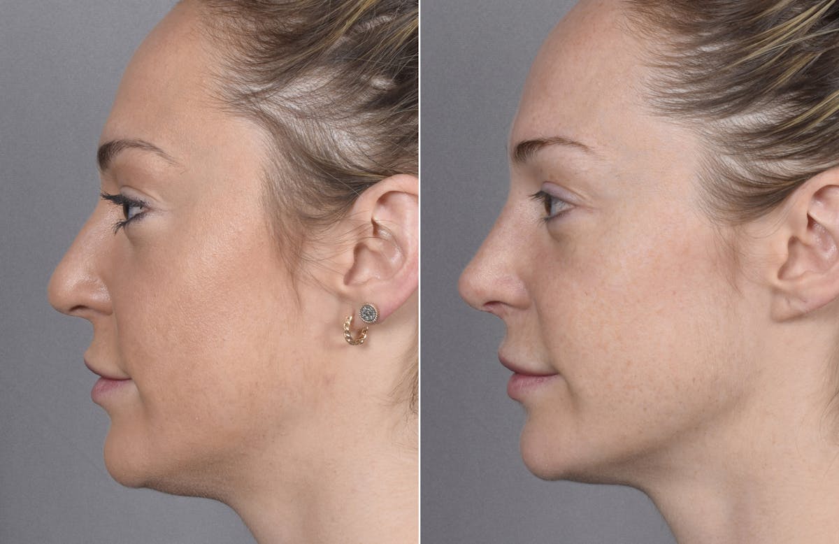Rhinoplasty Before & After Gallery - Patient 347275 - Image 1