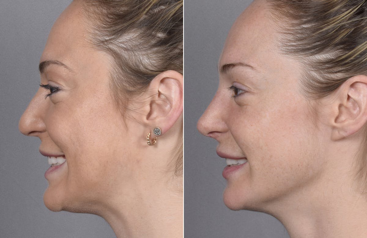 Rhinoplasty Before & After Gallery - Patient 347275 - Image 2