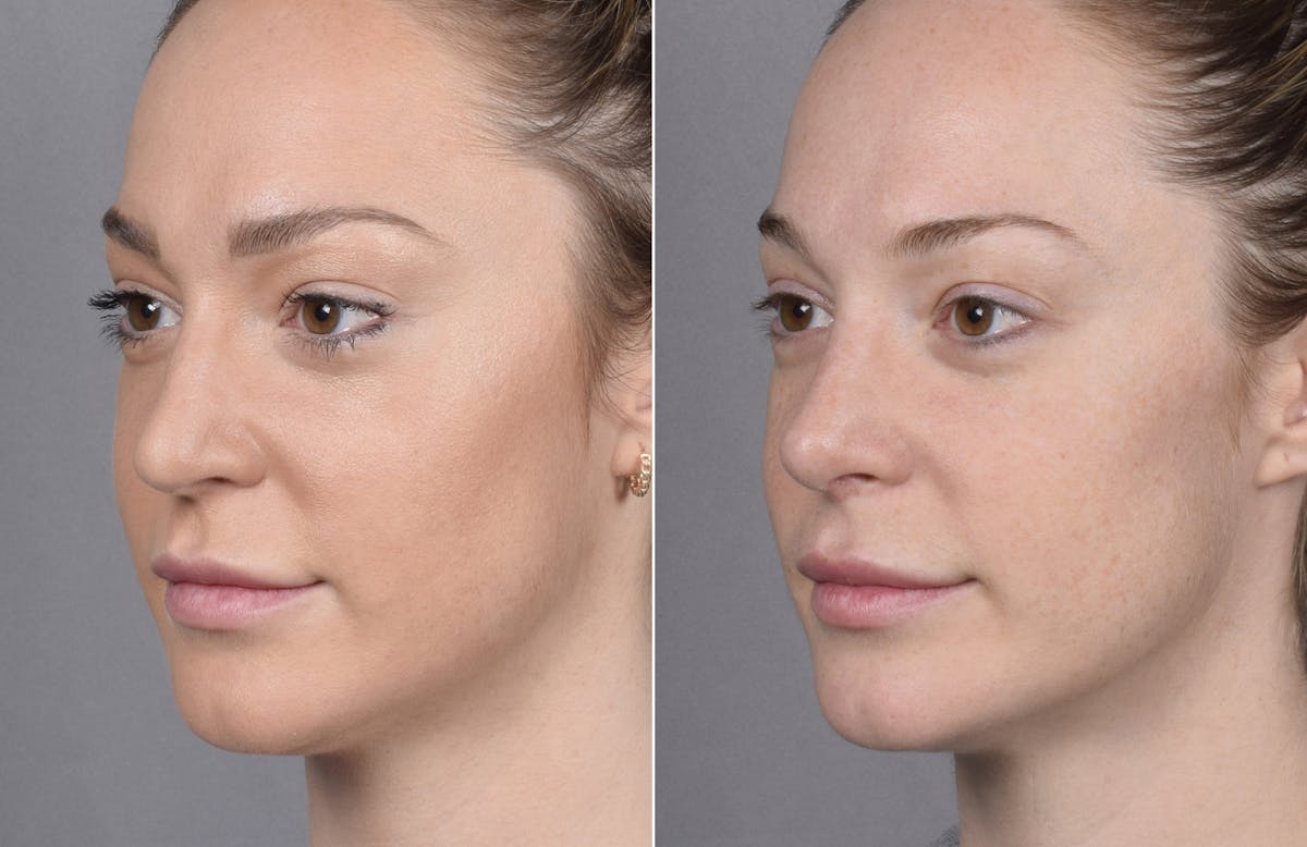 Rhinoplasty Before & After Gallery - Patient 347275 - Image 5