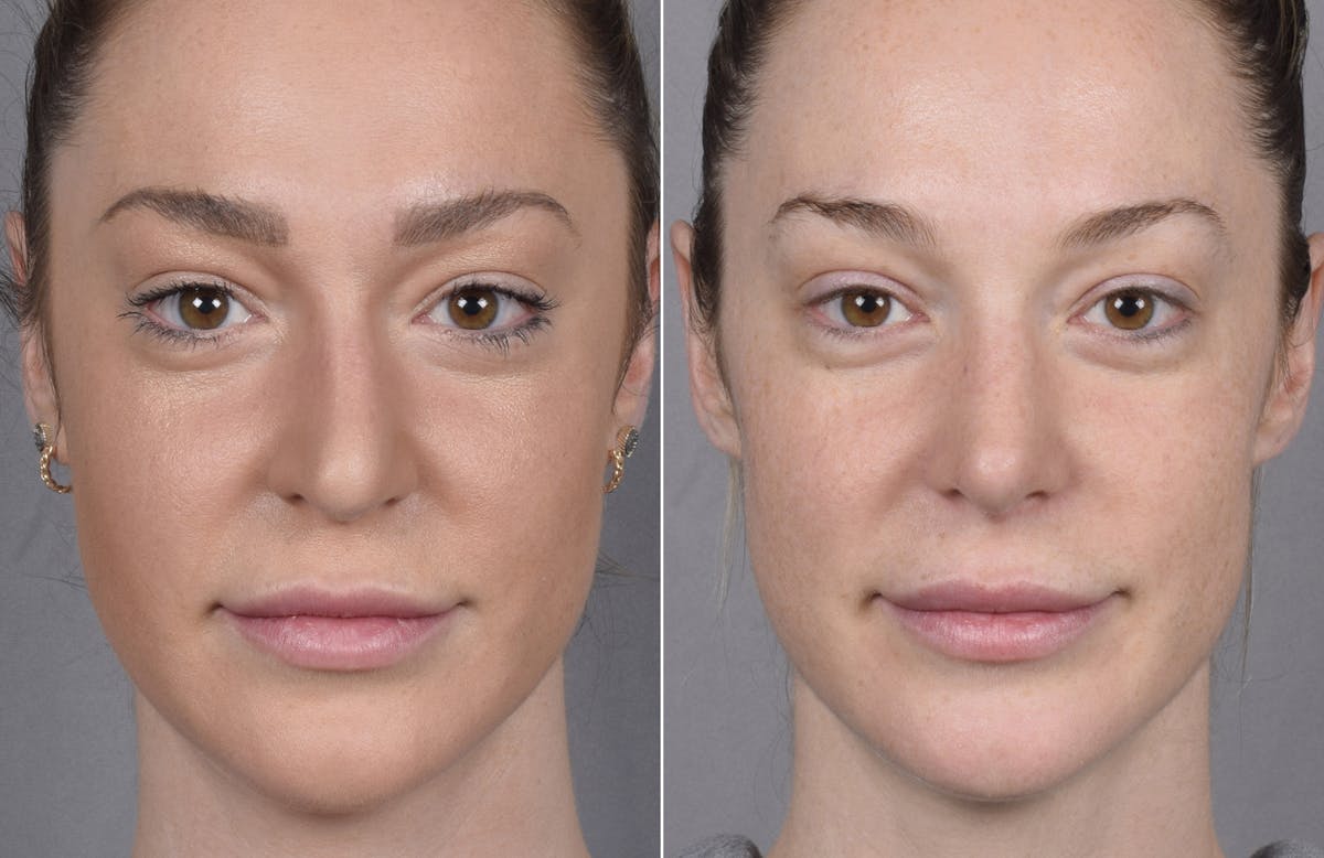 Rhinoplasty Before & After Gallery - Patient 347275 - Image 7