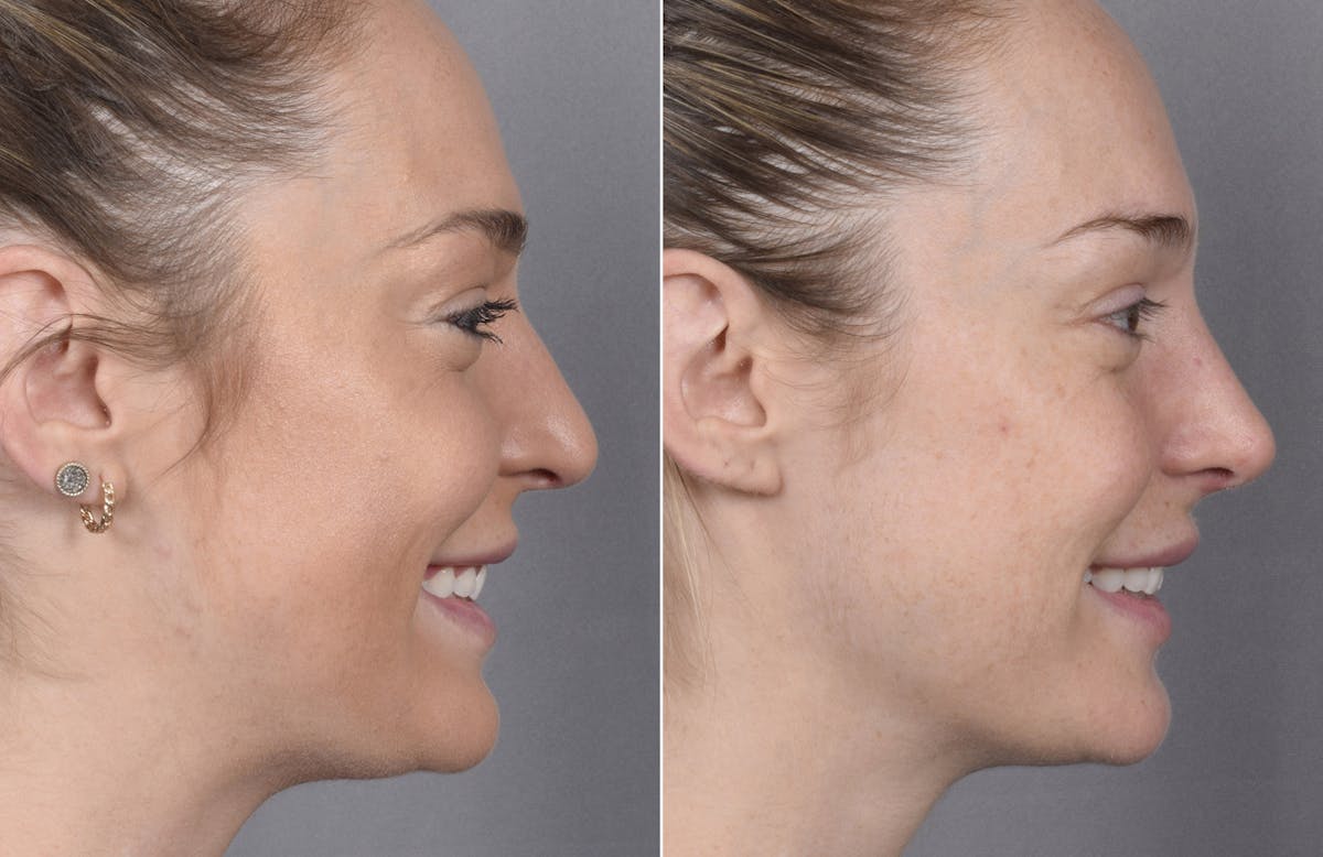 Rhinoplasty Before & After Gallery - Patient 347275 - Image 4