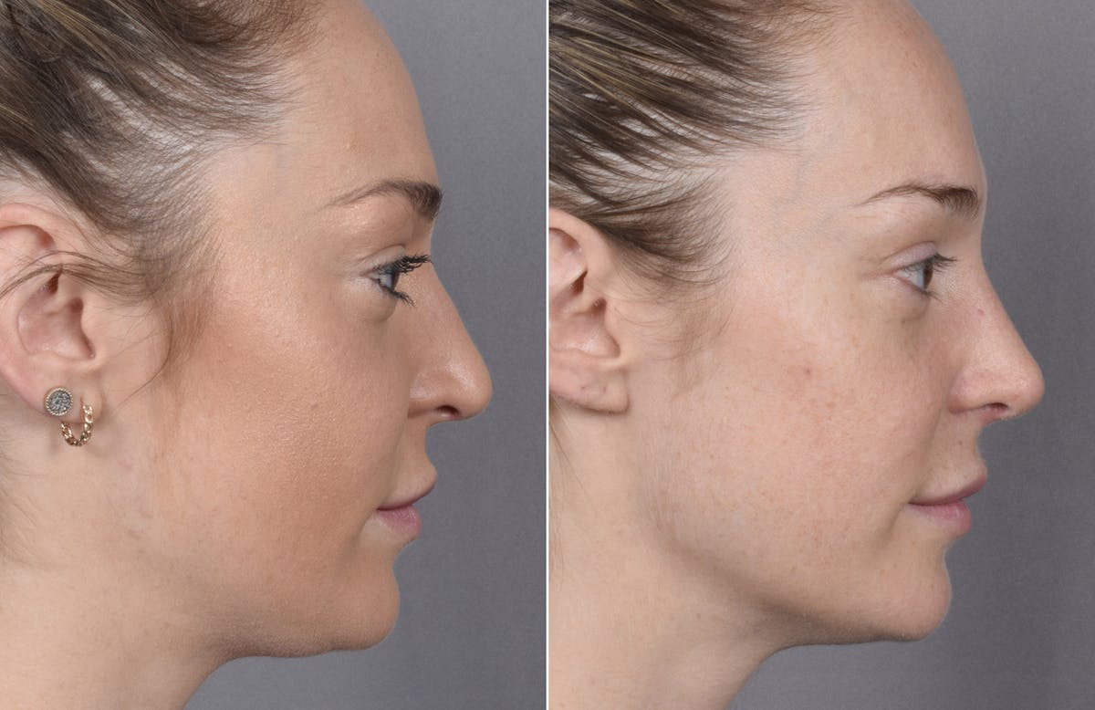 Rhinoplasty Before & After Gallery - Patient 347275 - Image 3