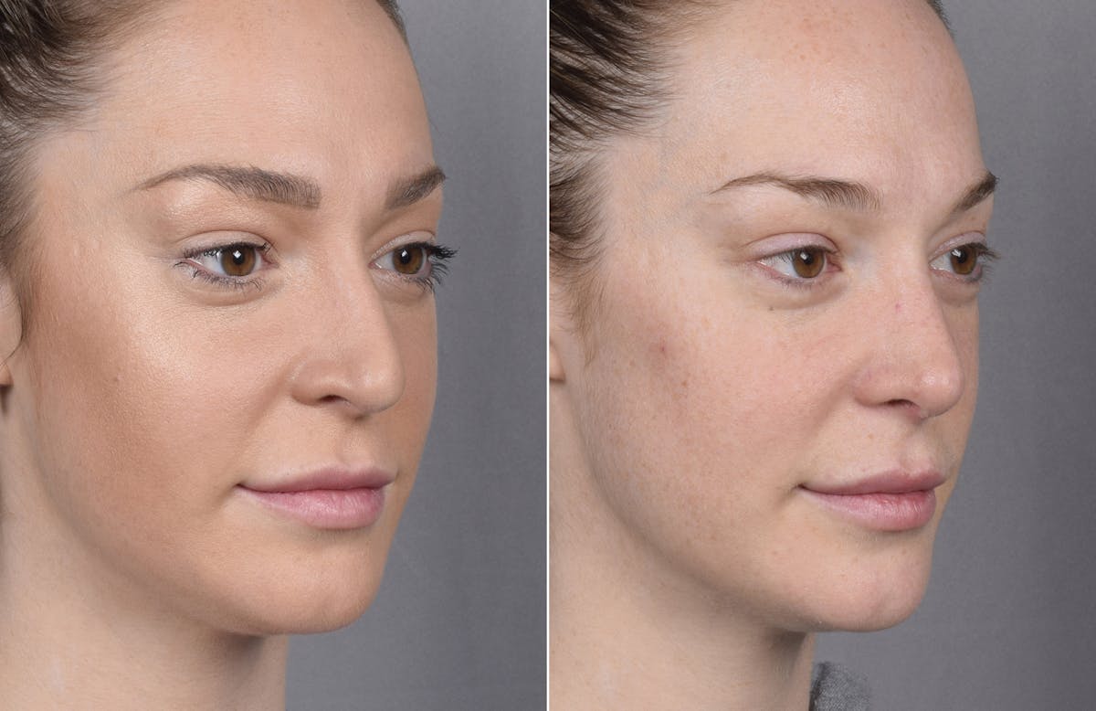 Rhinoplasty Before & After Gallery - Patient 347275 - Image 6