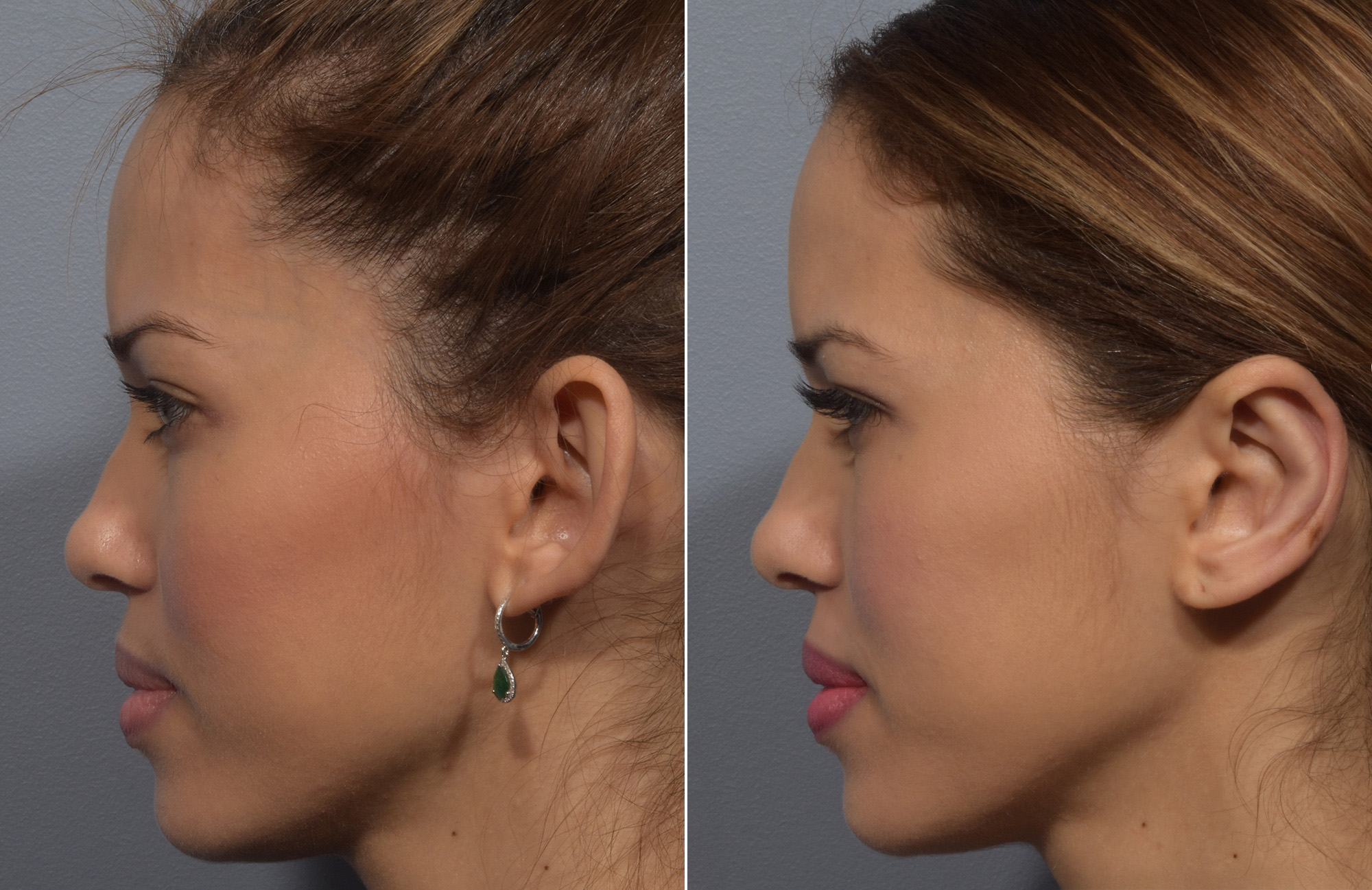 Otoplasty Before & After Gallery - Patient 228790 - Image 2