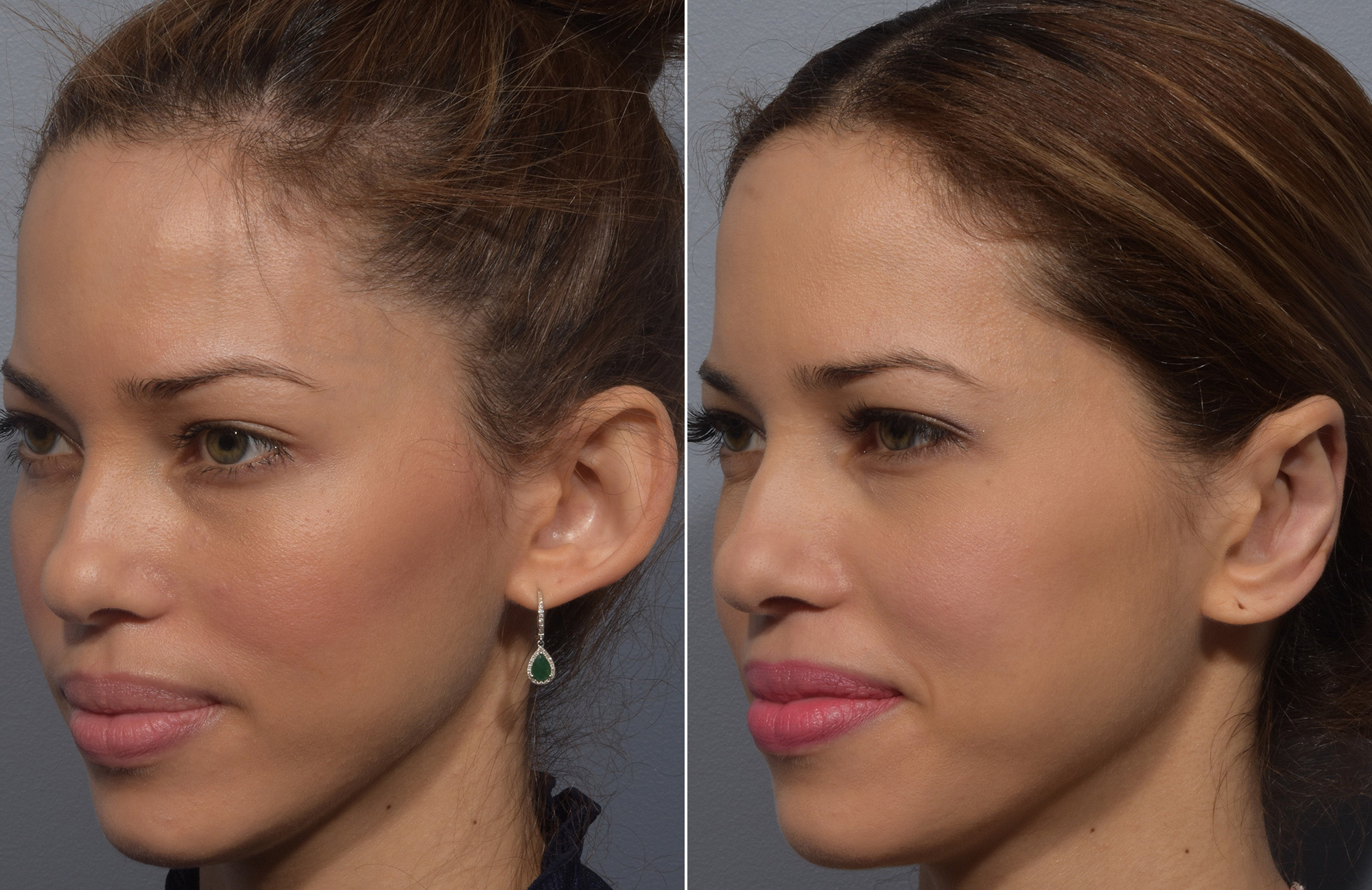 Otoplasty Before & After Gallery - Patient 228790 - Image 3