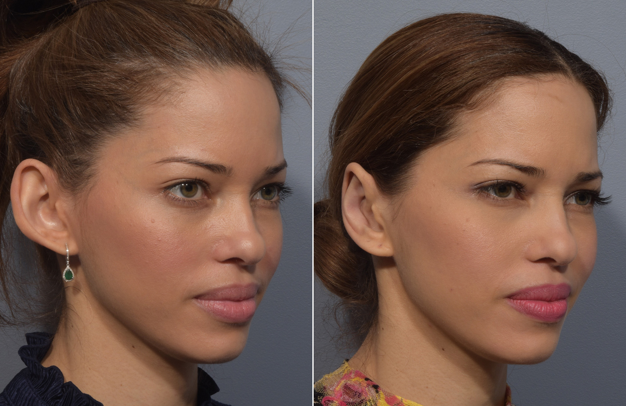 Otoplasty Before & After Gallery - Patient 228790 - Image 5