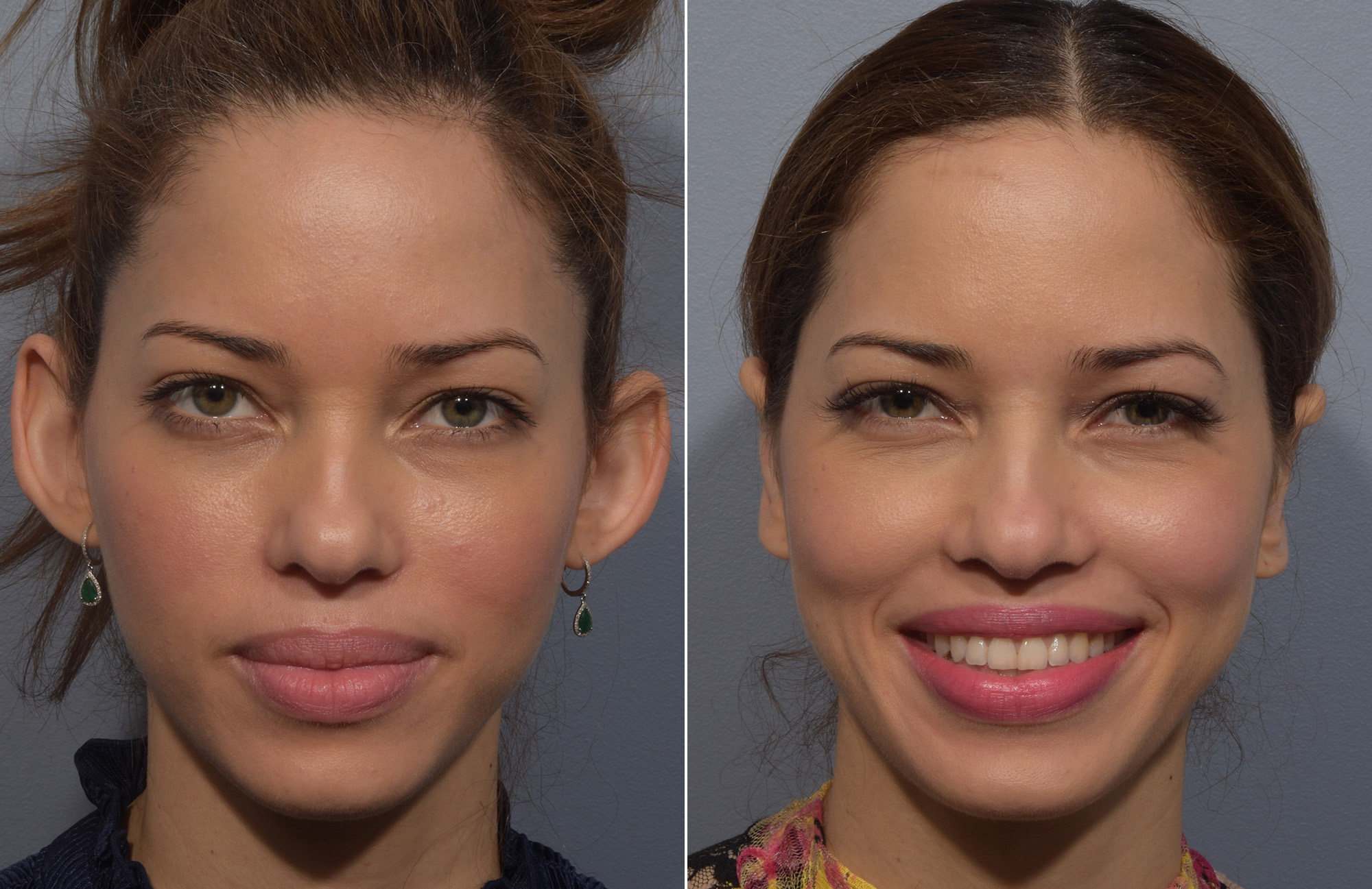 Otoplasty Before & After Gallery - Patient 228790 - Image 1