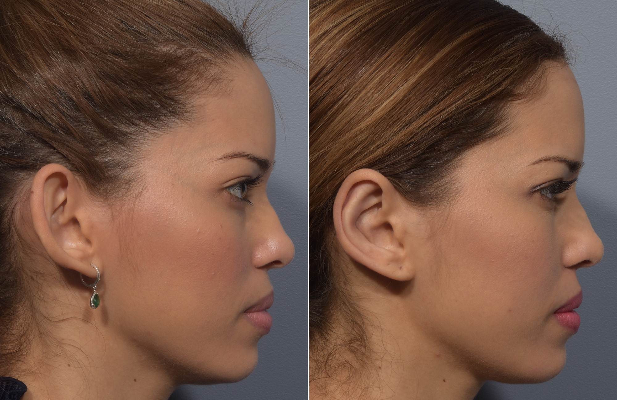 Otoplasty Before & After Gallery - Patient 228790 - Image 4