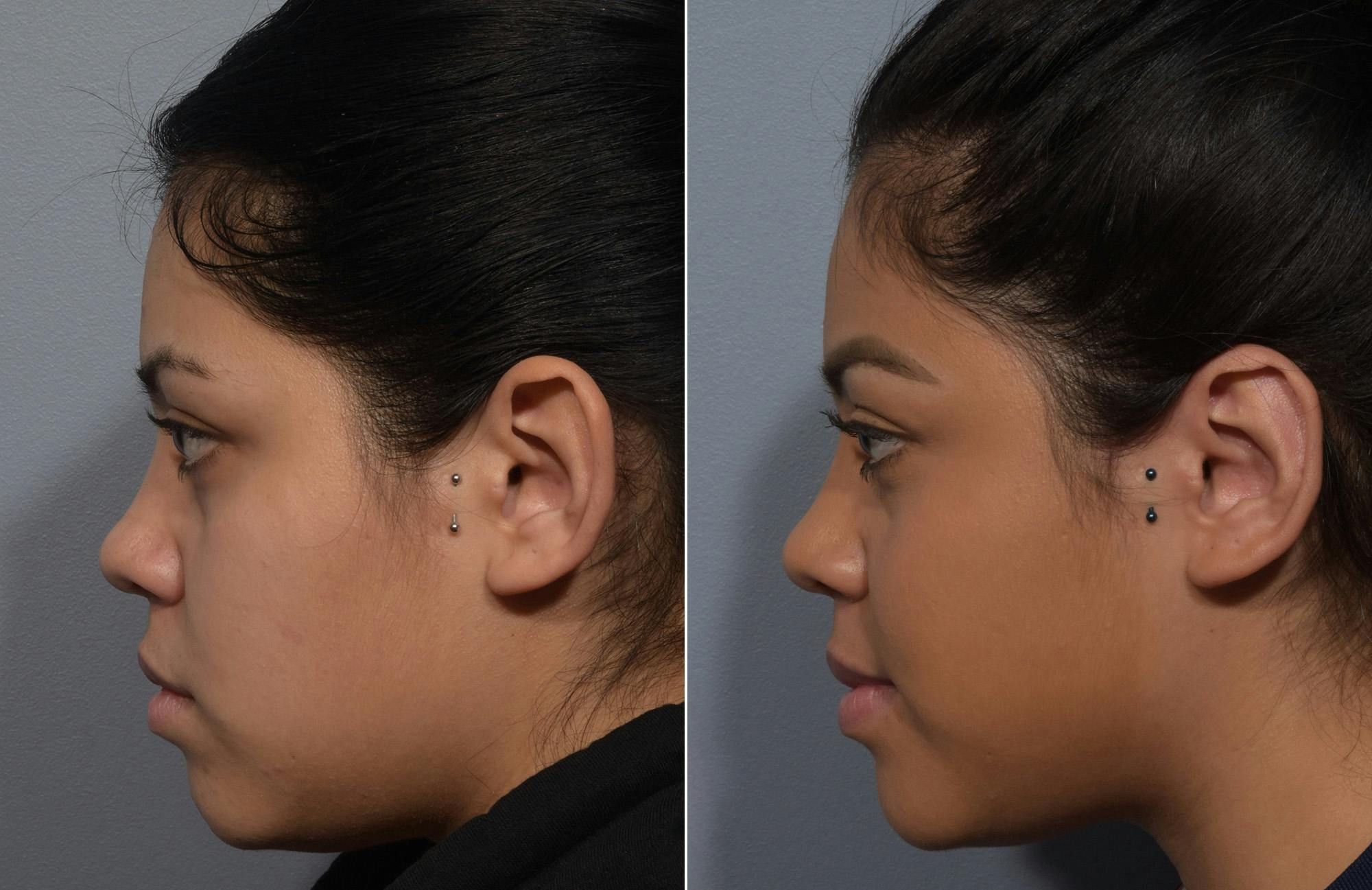 Otoplasty Before & After Gallery - Patient 172518 - Image 5