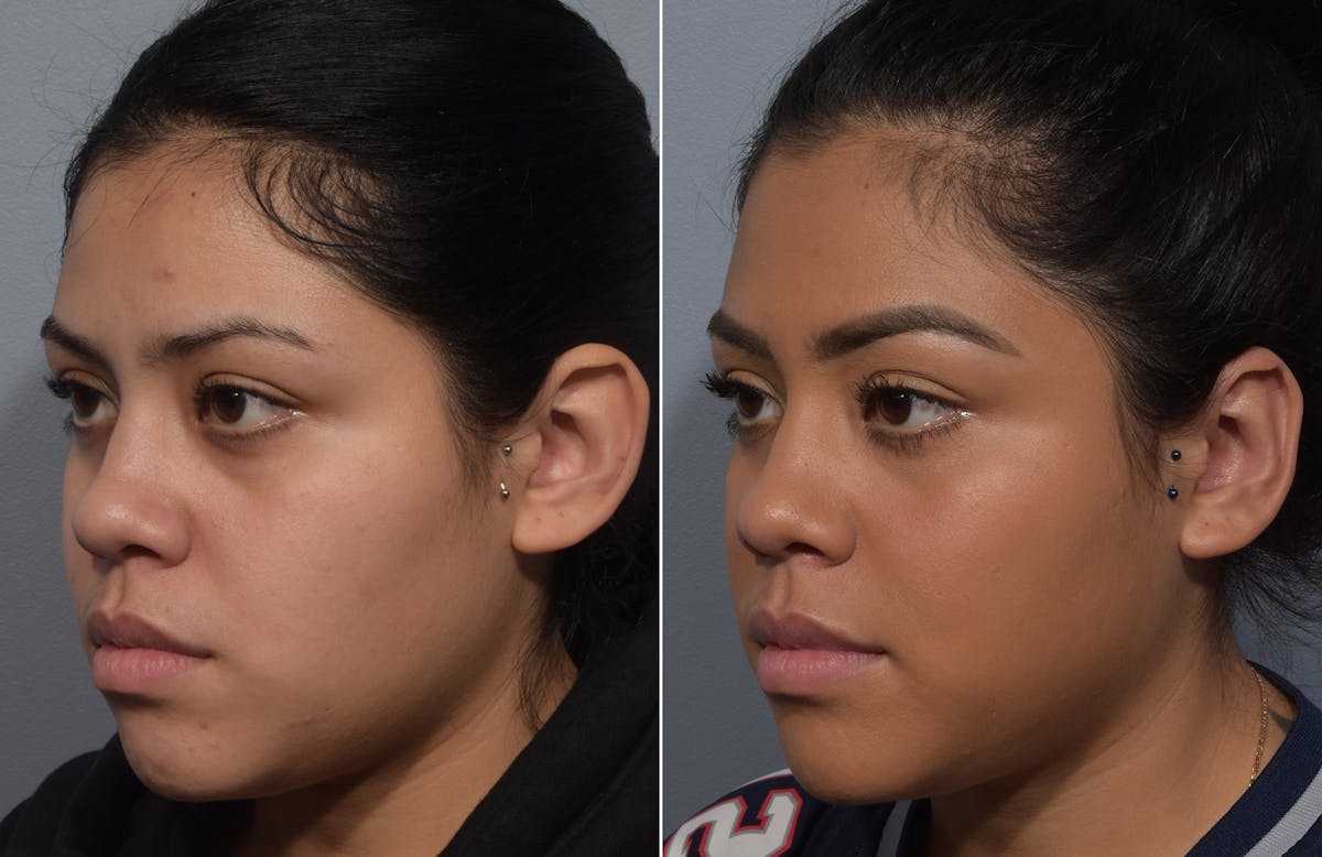 Otoplasty Before & After Gallery - Patient 172518 - Image 4