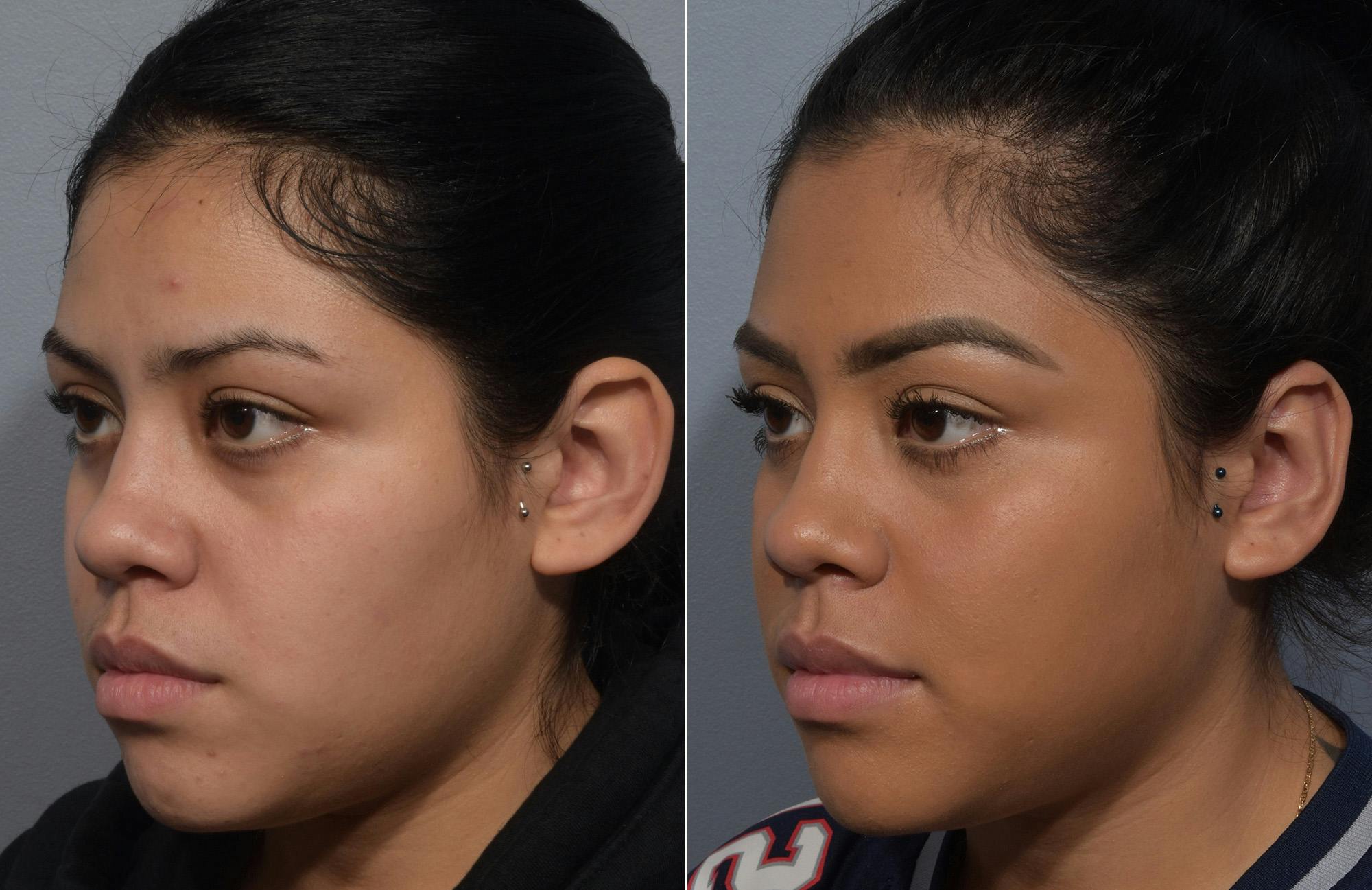 Otoplasty Before & After Gallery - Patient 172518 - Image 4