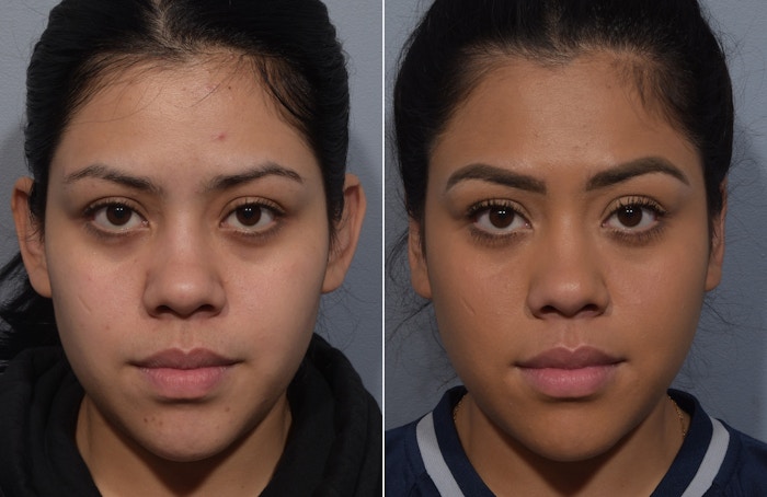 Otoplasty Before & After Gallery - Patient 172518 - Image 1