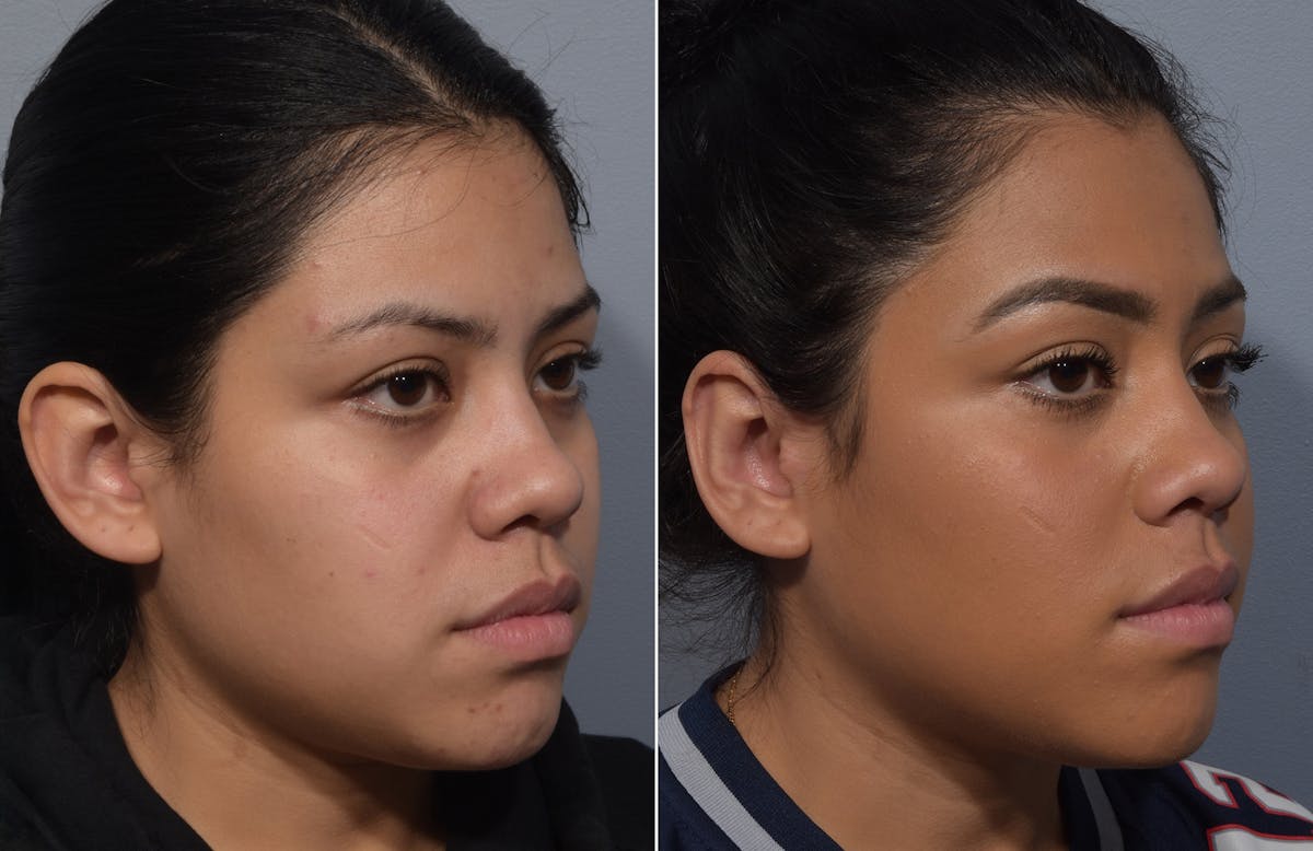 Otoplasty Before & After Gallery - Patient 172518 - Image 2