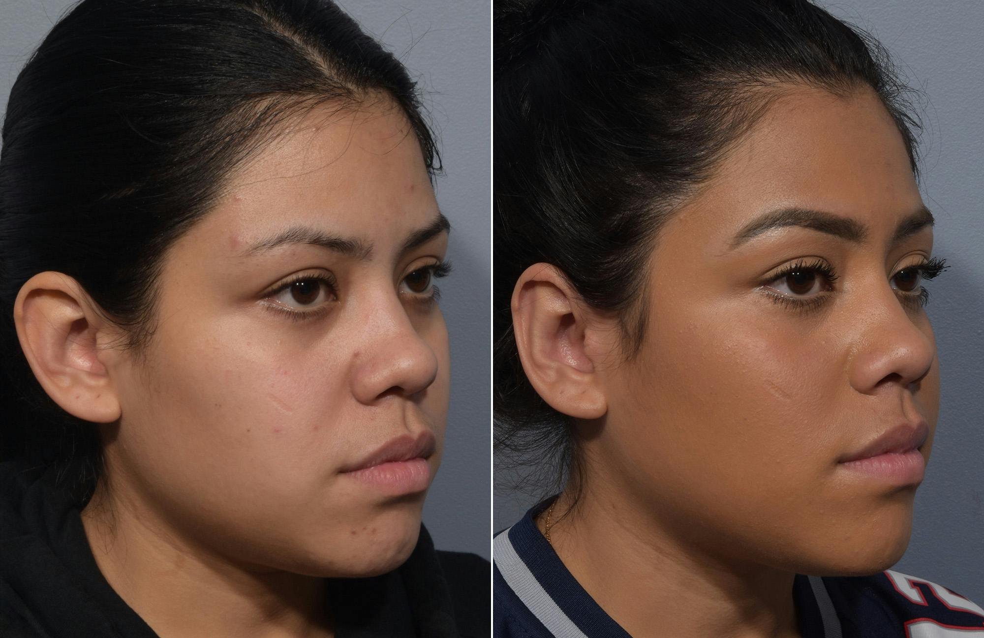 Otoplasty Before & After Gallery - Patient 172518 - Image 2