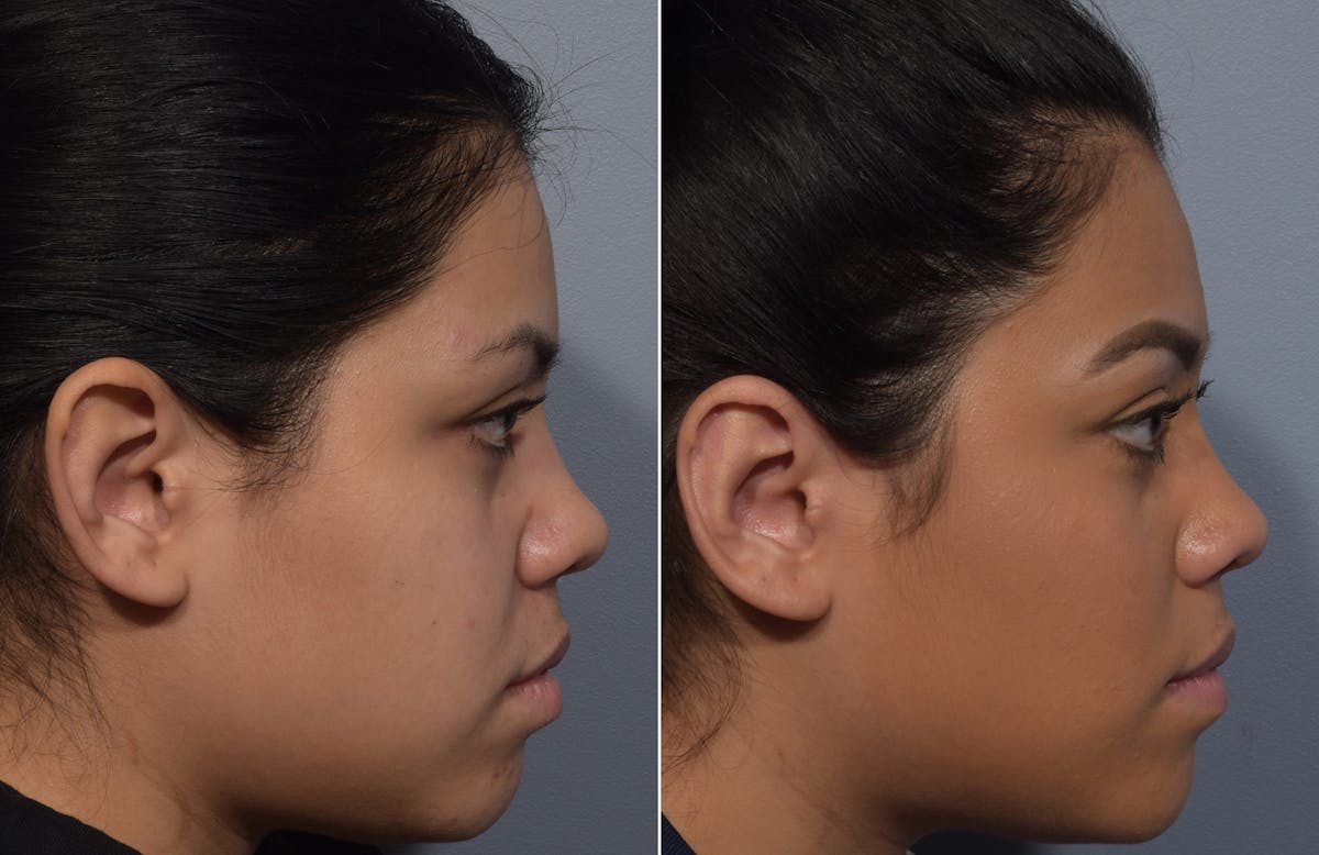 Otoplasty Before & After Gallery - Patient 172518 - Image 3
