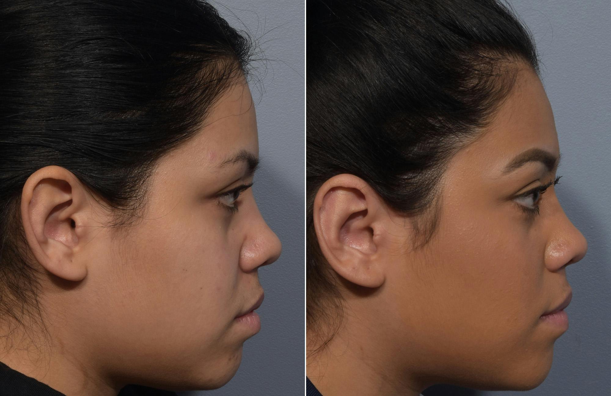 Otoplasty Before & After Gallery - Patient 172518 - Image 3