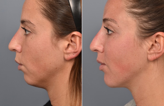 Liposuction Before & After Gallery - Patient 341855 - Image 1