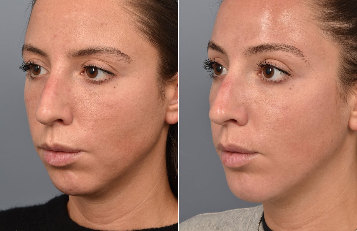 Liposuction Before & After Gallery - Patient 341855 - Image 2