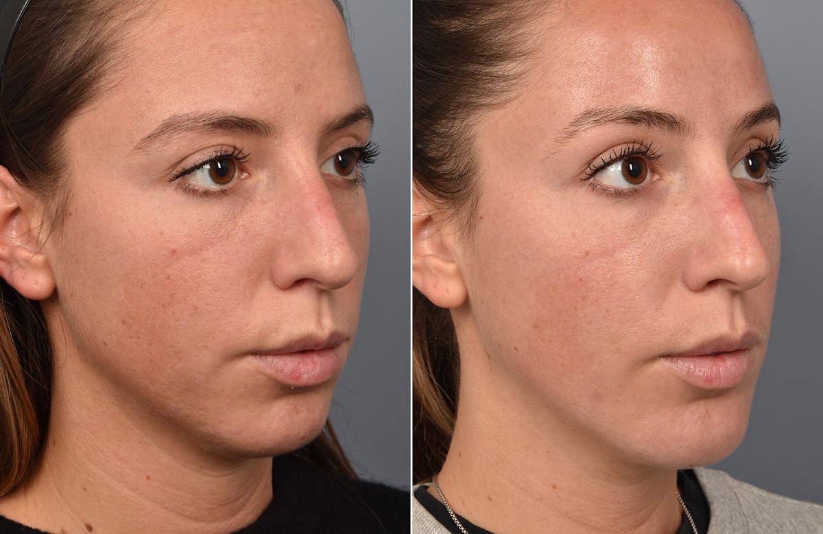 Liposuction Before & After Gallery - Patient 341855 - Image 5