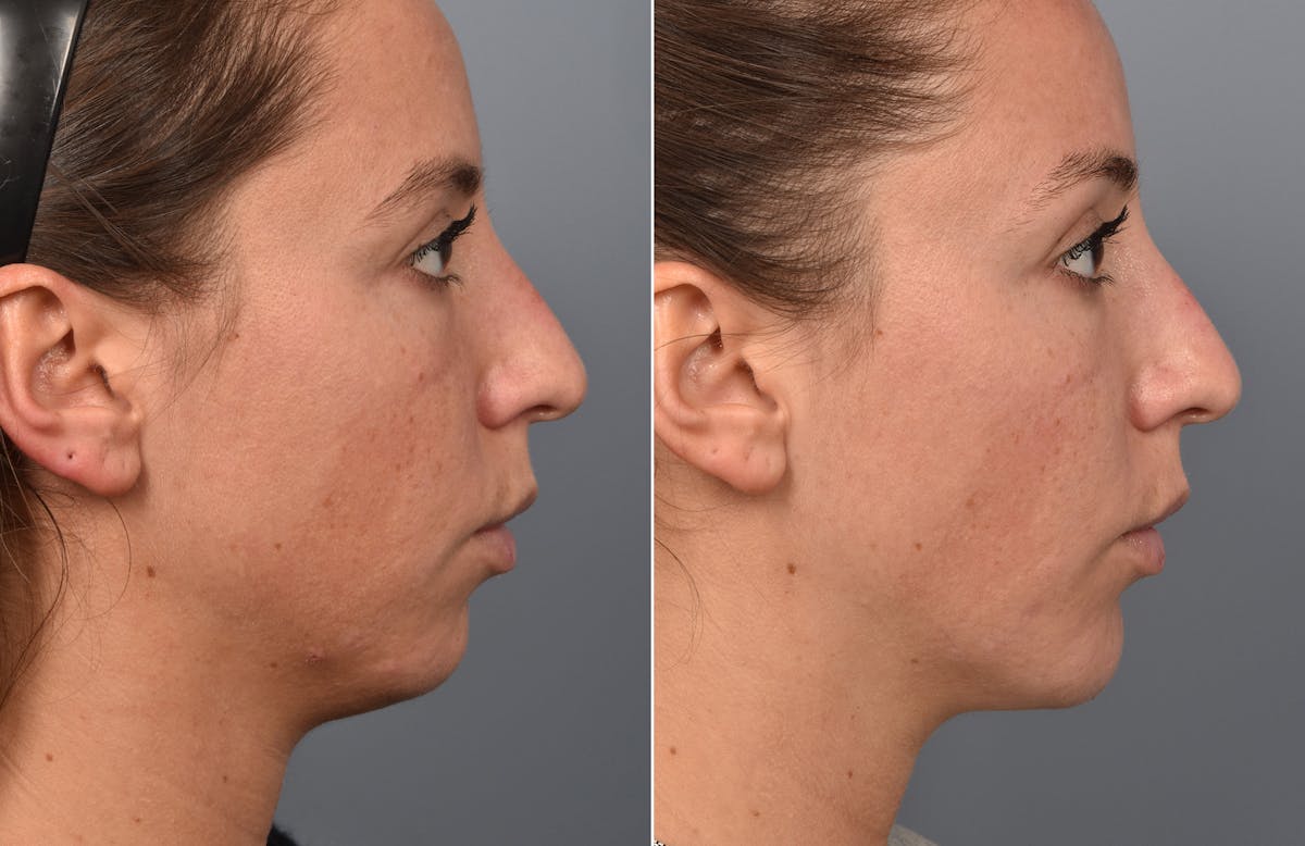 Liposuction Before & After Gallery - Patient 341855 - Image 3