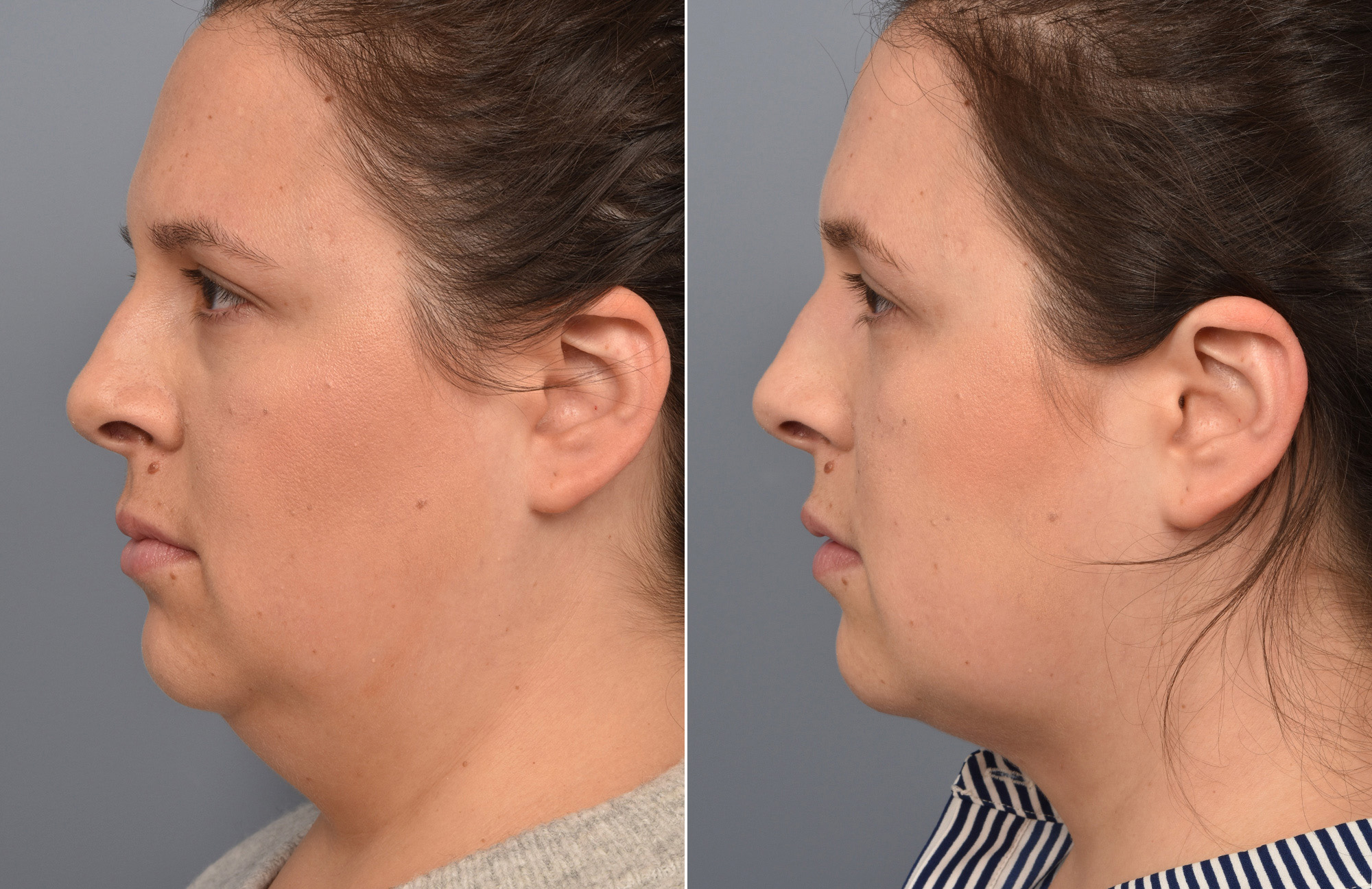 Liposuction Before & After Gallery - Patient 416514 - Image 1