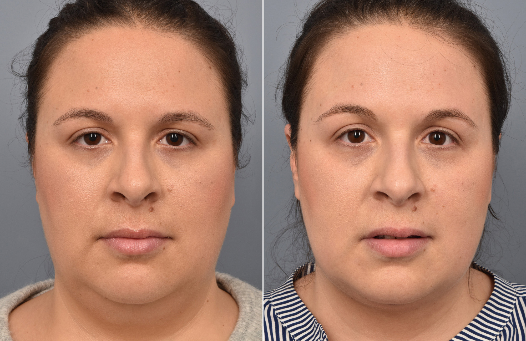Liposuction Before & After Gallery - Patient 416514 - Image 3