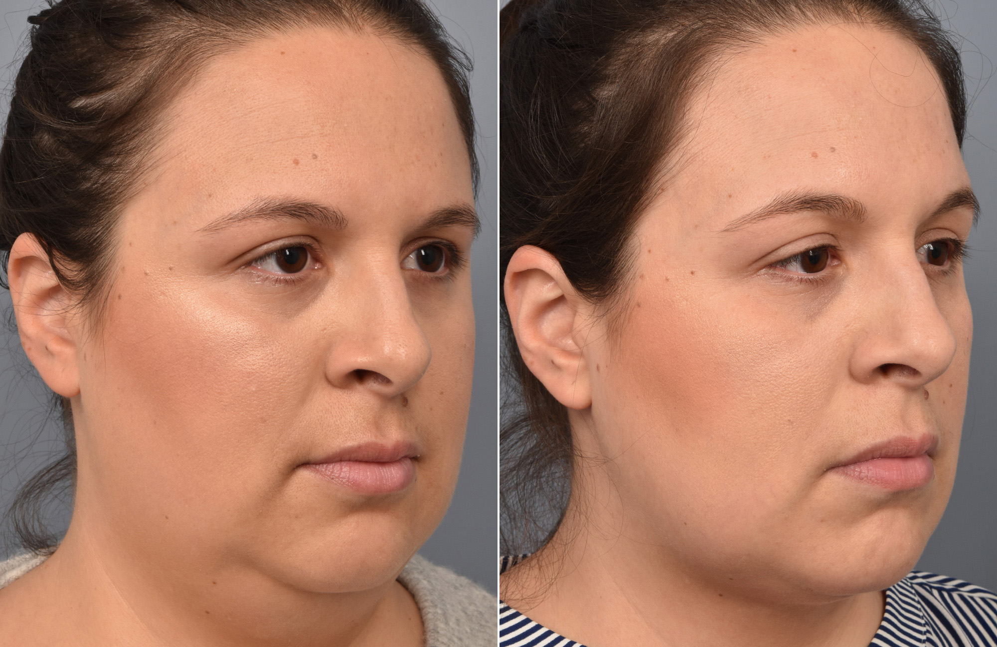 Liposuction Before & After Gallery - Patient 416514 - Image 4