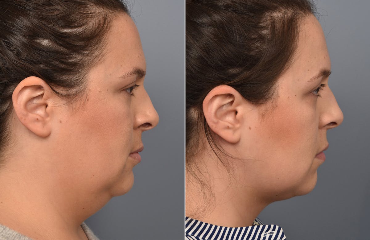Liposuction Before & After Gallery - Patient 416514 - Image 2