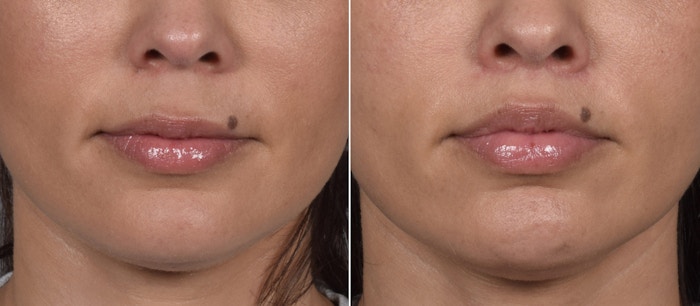 Lip Lift Before & After Gallery - Patient 901051 - Image 1