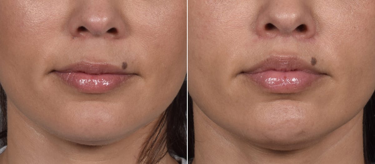Lip Lift Before & After Gallery - Patient 901051 - Image 1