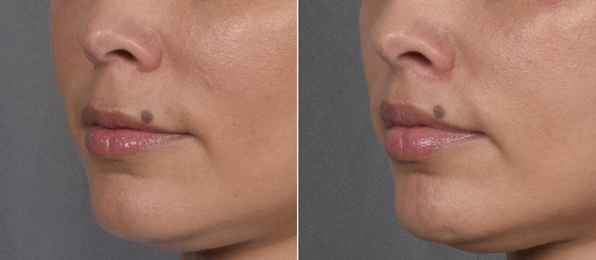 Lip Lift Before & After Gallery - Patient 901051 - Image 2