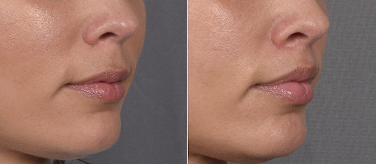 Lip Lift Before & After Gallery - Patient 901051 - Image 3