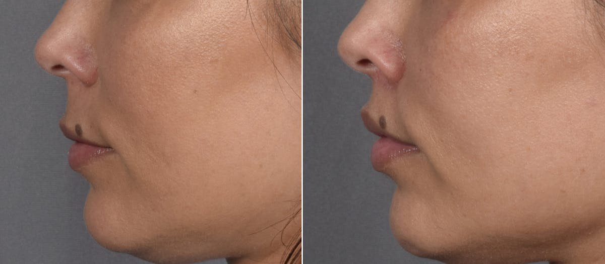 Lip Lift Before & After Gallery - Patient 901051 - Image 4
