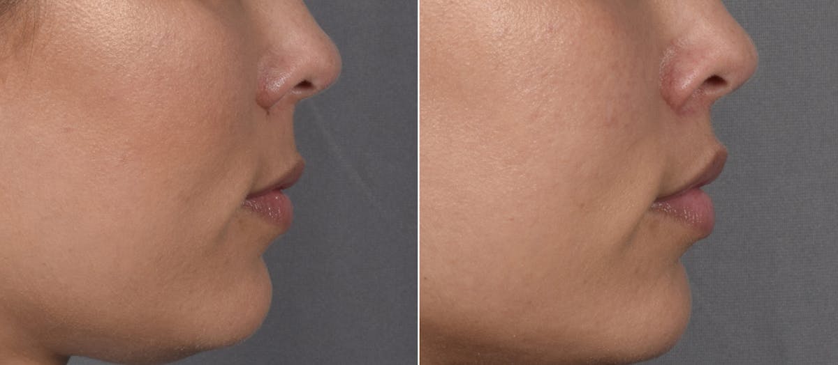 Lip Lift Before & After Gallery - Patient 901051 - Image 5