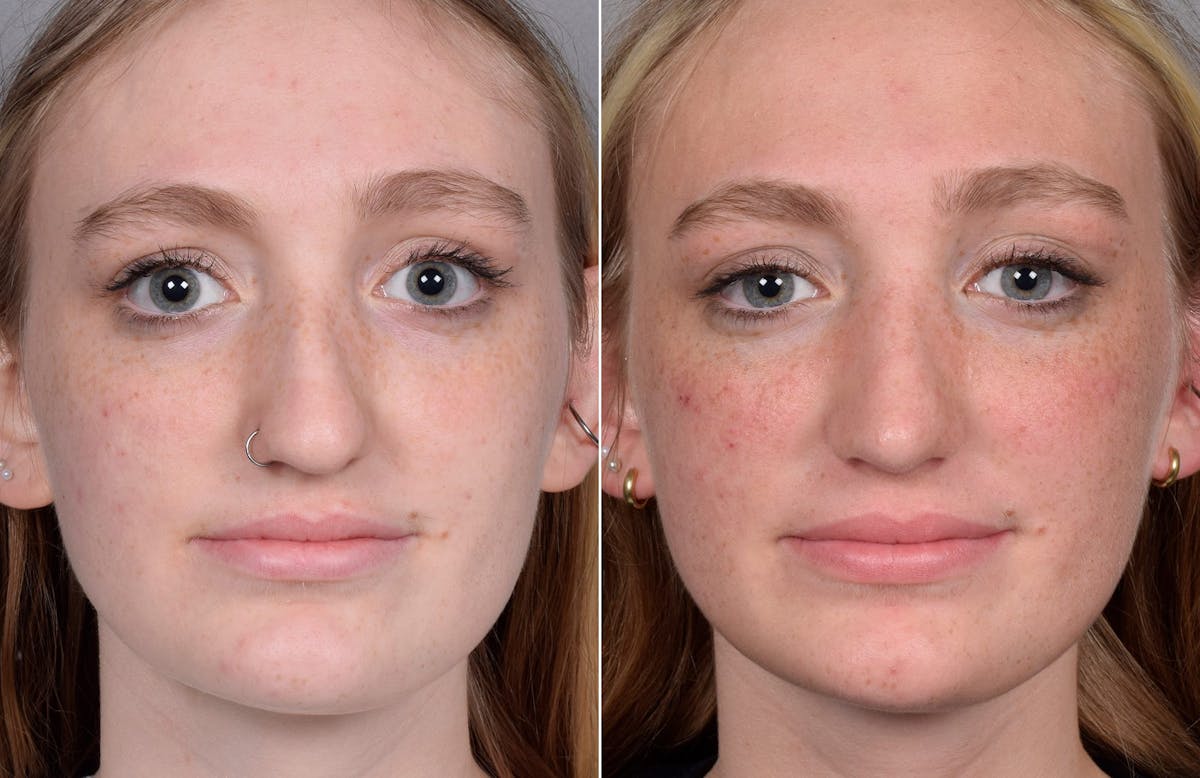 Rhinoplasty Before & After Gallery - Patient 260396 - Image 2