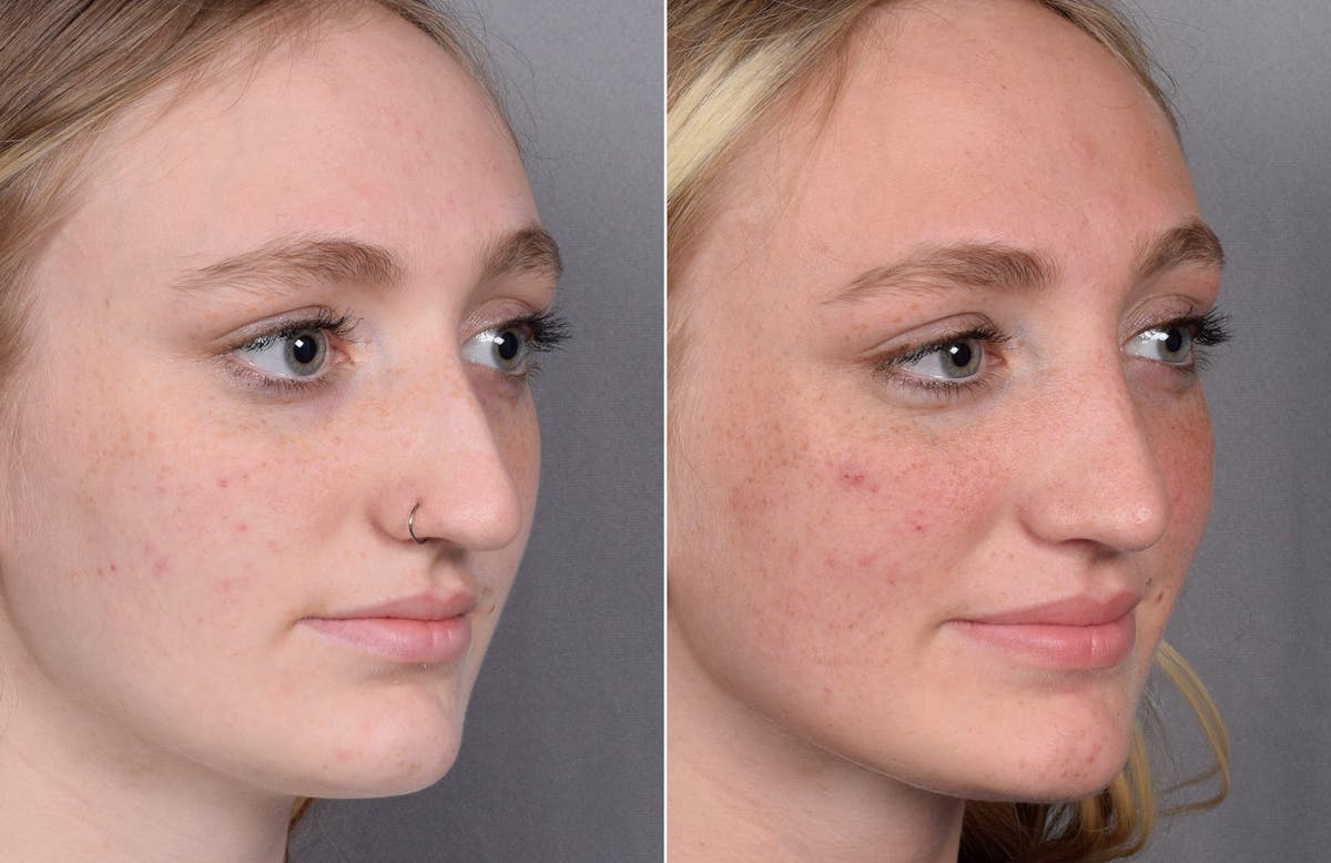 Rhinoplasty Before & After Gallery - Patient 260396 - Image 4