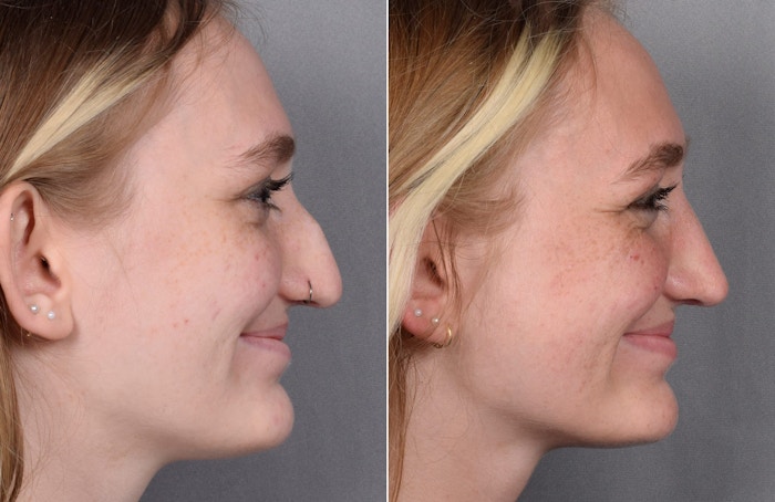 Rhinoplasty Before & After Gallery - Patient 260396 - Image 1
