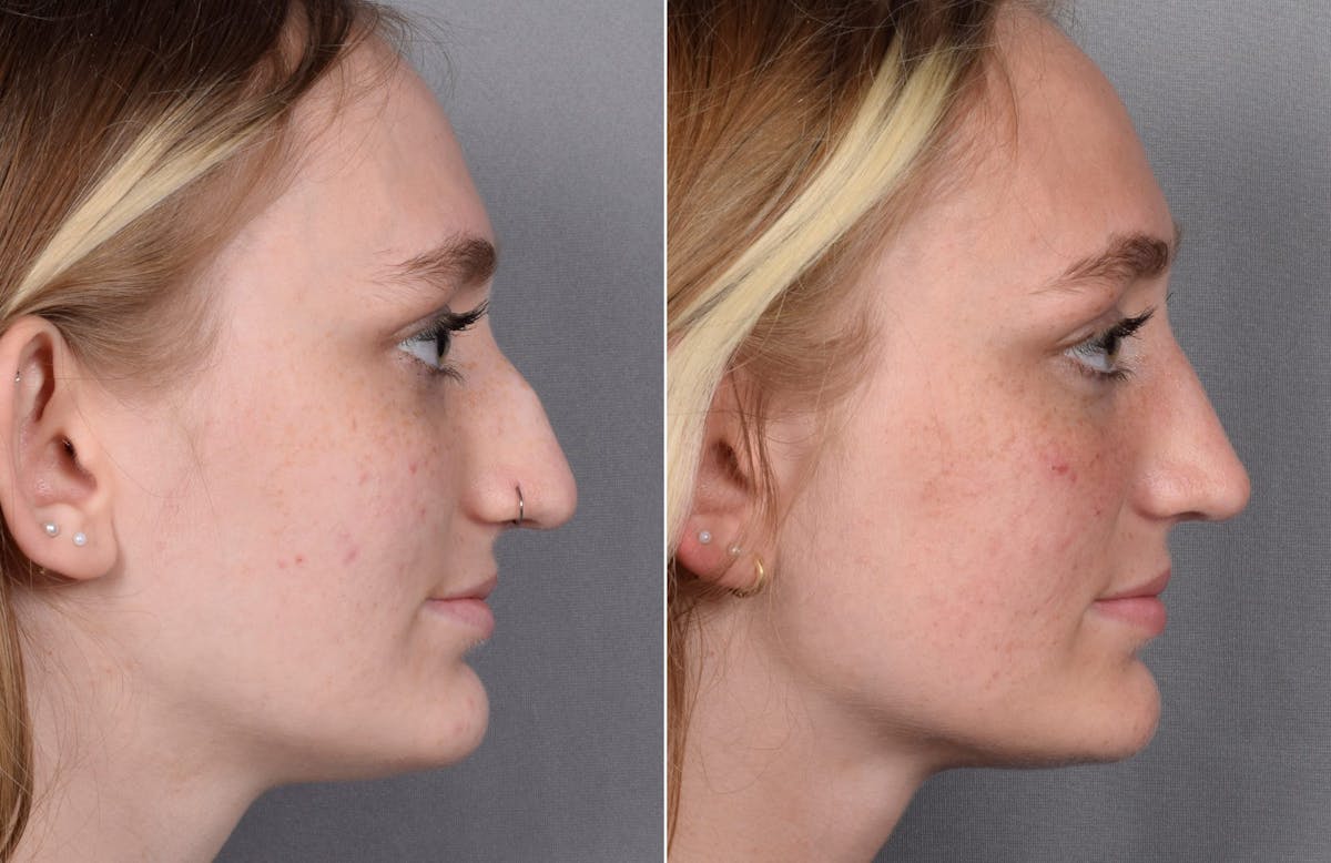 Rhinoplasty Before & After Gallery - Patient 260396 - Image 3
