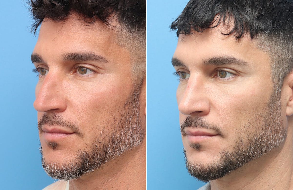 Rhinoplasty Before & After Gallery - Patient 264447 - Image 3
